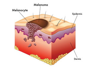 A mole is a natural formation, which can be removed with the use of the Skincell a curse.