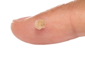 A wart is a disease of the skin that effectively fight the Skincell a curse.
